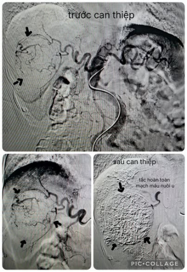 phuong phap nut mach hoa chat dieu tri u gan